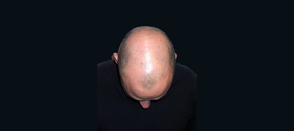 antes antes